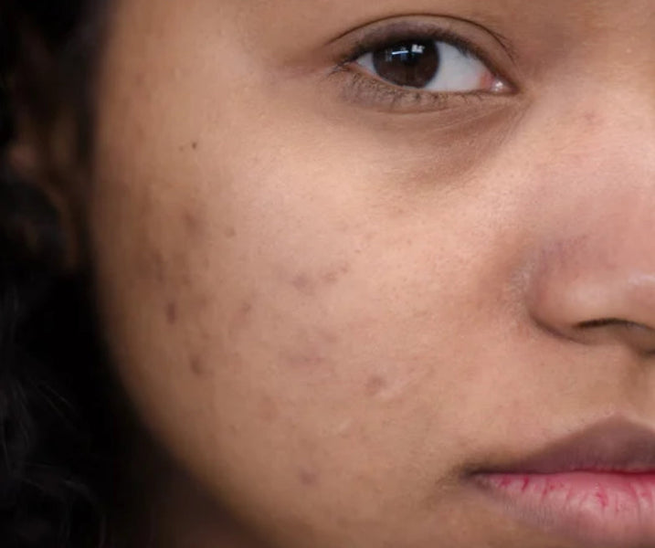 Nature's Remedy for Acne: The Power of Honey with Honey Corn